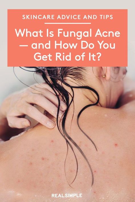 What Is Fungal Acne—and How Do You Get Rid of It? | Do you have a stubborn breakout on your chest, arms, or back that just won't give in to acne medication? You may have fungal acne (don’t worry, it’s not as gross as it sounds). A dermatologist shares skincare tips on how to treat and help prevent fungal acne. #beautytips #realsimple #skincare #makeuphacks #bestmakeup Anti Fungal Remedies For Skin, Arm Acne, Back Acne Remedies, Acne Medication, Acne Tips, Chest Acne, Blind Pimple, Fungal Acne, Pimples Under The Skin