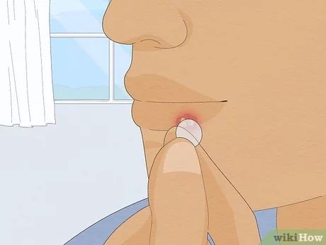 How To Get Rid Of A Cold Sore Fast, How To Get Rid Of Cold Sores Overnight, Cold Sore Remedy Fast, Cold Sore Remedy Overnight, Cold Sore Stages, Cold Sore Remedy, Cold Sore Relief, Aloe Vera For Sunburn, Remedies For Dry Mouth