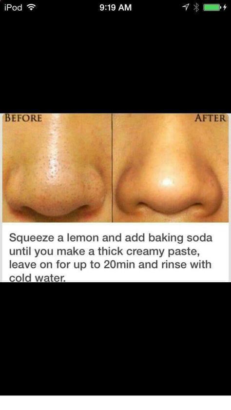 Obličejové Masky, Exposed Skin Care, Diy Acne, Smink Inspiration, Acne Remedies, Skin Pores, Skin Remedies, Dr Oz, Lifestyle Tips