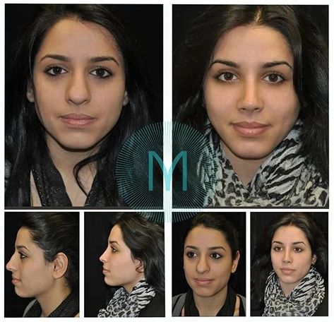 Closed Rhinoplasty, Nose Plastic Surgery, Ethnic Rhinoplasty, Bulbous Nose, Rhinoplasty Nose Jobs, Rhinoplasty Surgery, Job Inspiration, Pretty Nose, Wide Nose