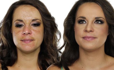 Best Foundation for Hyperpigmentation: 2017 Reviews Makeup For Pigmented Skin, How To Cover Pigmentation With Makeup, How To Cover Hyperpigmentation With Makeup, Camouflage Makeup, Makeup Youtube, Skin Pigmentation, Skin Hyperpigmentation, Brown Spots On Face, Spots On Face