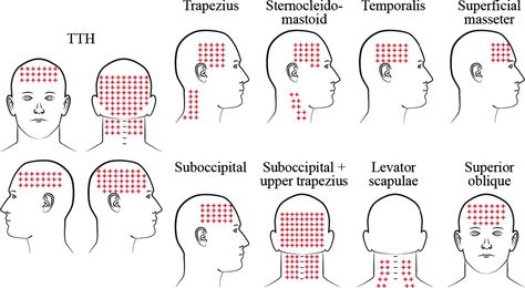 Head Aches Types Of, Headache Types Back Of Head, Headache Chart Causes, Dehydration Headache Location, Types Of Headaches Chart, Headache Location Meaning, Headache Back Of Head, Headache Location, Tension Headache Remedies