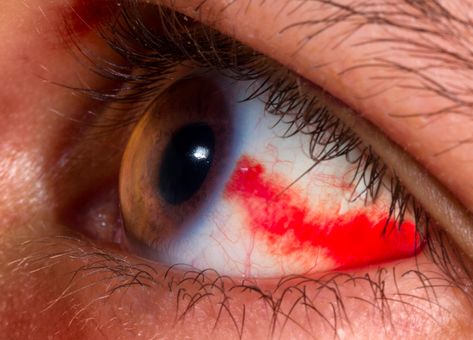 6 Health Issues Your Eyes Can Warn You About – Cleveland Clinic Blood In Eye, Blood Vessel In Eye, Stye Remedies, Eye Bleed, Eye Health Remedies, Strained Eyes, Blood Pressure Range, Bloodshot Eyes, Eye Twitching