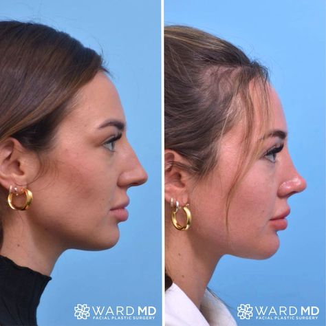 Rhinoplasty Side Profile Before & After Rhinoplasty Side Profile, Side Profile Before And After, Cast Aesthetic, Side Profile Woman, Kpop Plastic Surgery, Greek Nose, Jaw Reduction Surgery, Nose Plastic Surgery, Face Plastic Surgery