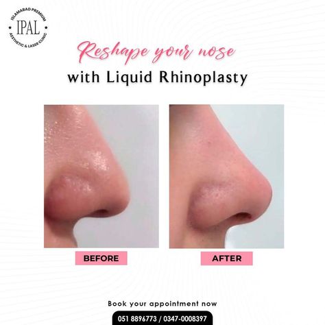 Non Surgical Nose Job Before After, Pixie Tip Lift Nose Filler, Filler Nose Job Before After, Liquid Nose Job Before And After, Nose Filler Before After Non Surgical, Liquid Rhinoplasty Before And After, Nose Filler Before After, Non Surgical Rhinoplasty, Liquid Rhinoplasty