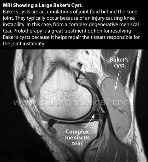 Knee Mri, Meniscal Tear, Knee Relief, Knee Pain Relief, Knee Surgery, Knee Injury, Knee Pain, Health Facts, Pain Relief