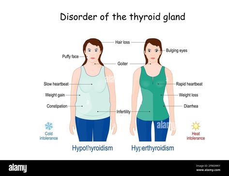 Download this stock vector: thyroid gland disorder. comparison and difference between Hyperthyroidism and Hypothyroidism. Signs and symptoms - 2FM2WKY from Alamy's library of millions of high resolution stock photos, illustrations and vectors. Symptoms Of Hypothyroid, Hyper Parathyroidism, Reversing Hypothyroid, Subclinical Hypothyroid, Hypo And Hyper Thyroidism, Home Remedies For Allergies, Bulging Eyes, Natural Remedies For Migraines, Thyroid Symptoms