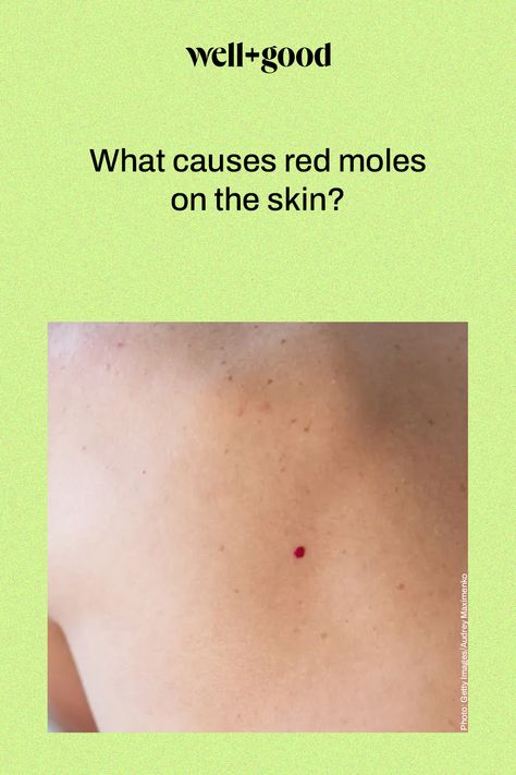 moles on skin Red Moles On Skin, Mole Meaning, Moles On Face, Red Moles, Skin Moles, Face Pores, Skin Growths, Skin Photo, Hair Remedies For Growth