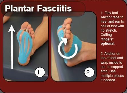 Facitis Plantar, K Tape, Kt Tape, Kinesio Taping, Ankle Pain, Kinesiology Taping, Athletic Training, Heel Pain, Foot Health