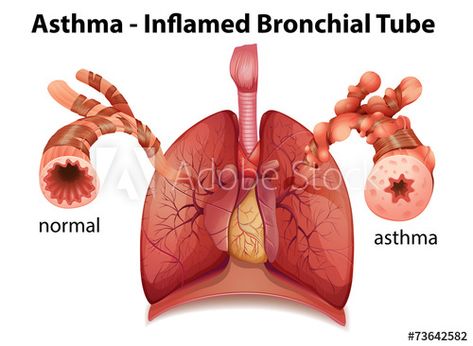 Natural Remedies For Asthma, Remedies For Asthma, Bronchial Asthma, Essential Oils For Asthma, Mullein Tea, What Is Asthma, Natural Asthma Remedies, Asthma Remedies, Asthma Relief