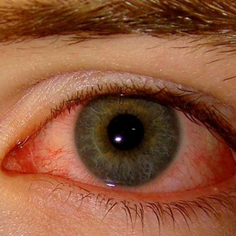 Natural Remedies for Dry Eyes Dry Eye, Remedies For Eyesight, Red Eyes Remedy, Dry Eyes Remedy Natural Treatments, Diy Eye Drops For Dry Eyes, Eye Irritation Remedies, Eye Drops For Dry Eyes, Eye Drops For Red Eyes, Dry Eye Remedies