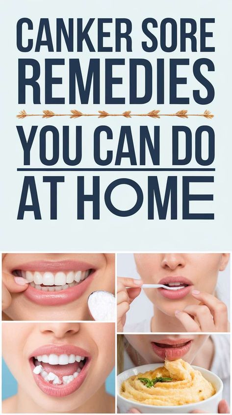 Discover natural and effective canker sore remedies that you can easily do at home. Say goodbye to the pain with these simple tips! #cankersore #homeremedies