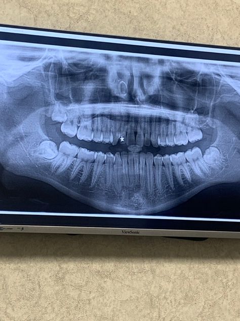 Wisdom Teeth, X Ray