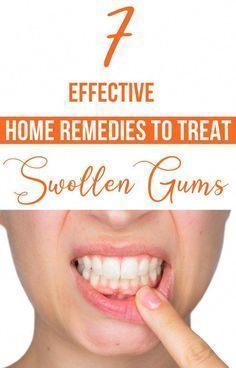 #dentist #receding gums #OralHygieneCare #WhatAreOralCare #WhatIsOralCare #HowToCareForOralHealth Baby Tooth Decay, Tooth Cavity, Tooth Decay Remedies, Tooth Repair, Swollen Gum, Dental Health Care, Homemade Cosmetics, Stronger Teeth, Dental Humor