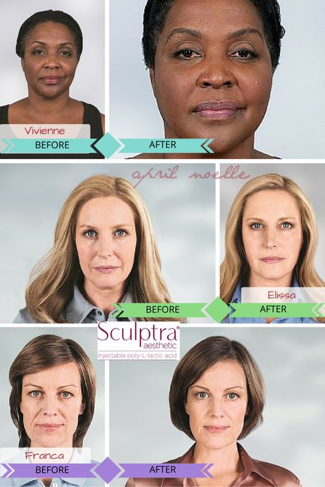 Sculptra Aesthetic Before and After Photos Sculptra Before And After Faces, Sculptra Before And After, Sculptra Aesthetic, Plastic Surgery Gone Wrong, Informed Consent, Celebrity Plastic Surgery, Under The Knife, Lifestyle Blogs, Chic Fall Outfits