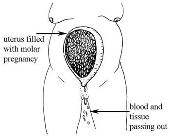 Fundal Height, Antenatal Care, 2 Months Pregnant, Molar Pregnancy, Child Nursing, Session 9, Losing A Baby, Amniotic Fluid, Gestational Age