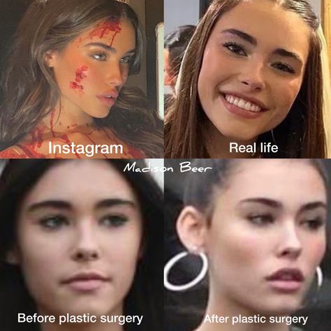 Madison Beer plastic surgery 2022 now and then natural vs after fillers and surgery Madison Beer Teeth, Before And After Plastic Surgeries, Madison Beer Before And After Surgery, Madison Beer Nose Profile, Madison Beer Plastic Surgery, Madison Beer Face Morph, Madison Beer Crying, Cindy Kimberly Madison Beer Face Morph, Acne Makeup