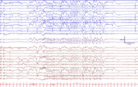 Psychogenic Non-Epileptic Seizures in a Surgical Epilepsy Unit: Experience and a Comprehensive Review | IntechOpen Non Epileptic Seizures, Seizures Non Epileptic, Epileptic Seizures, Post Traumatic, Patient Experience, Coping Strategies, Personality Disorder, The Unit, Health