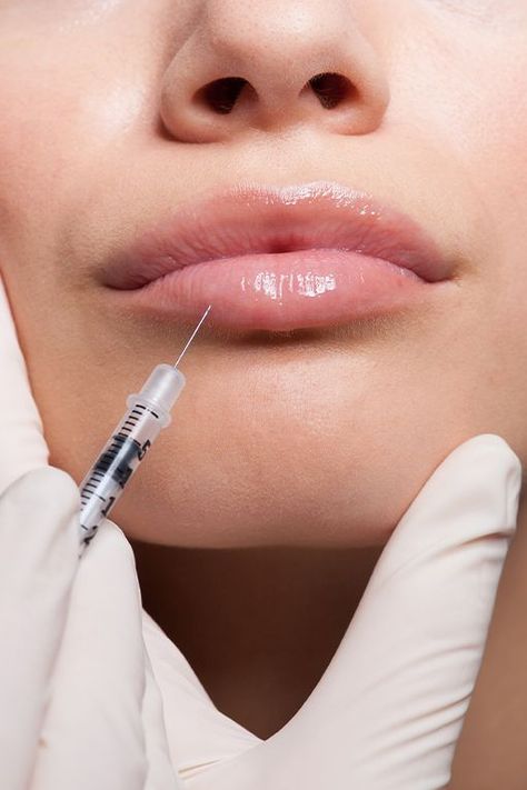 Understand the implications when lip filler doesn't dissolve. Explore insights into managing potential complications. Lip Filler Inspiration, Lip Filler, Beauty Images, Lip Fillers, Beauty Inspiration, Lips, Collage, Pins, Beauty