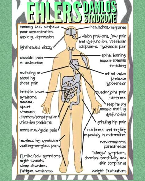 EDS symptom chart Ehlers Danlos Syndrome Symptoms, Elhers Danlos Syndrome, Ehlers Danlos Syndrome Hypermobility, Ehlers Danlos Syndrome Awareness, Guillain Barre, Mast Cell Activation Syndrome, Jaw Pain, Restless Leg Syndrome, Ehlers Danlos