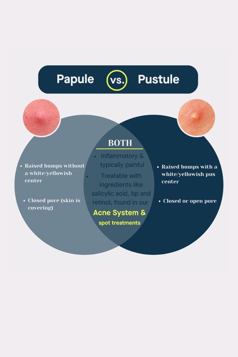 NOT ALL PIMPLES ARE POPPABLE 📣 Learn the differences between PAPULES and PUSTULES and how to treat them in our blog.⁠ Types Of Pimples, Papules Acne, Inflammatory Acne, Nose Pimples, Pimple Causes, Covering Acne, Salicylic Acid Cleanser, Mild Acne, Post Inflammatory Hyperpigmentation