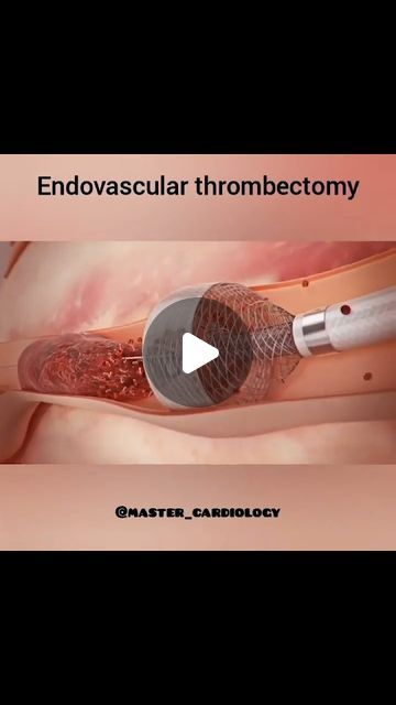 CardioVisual: Powered By MedicalVisual on Instagram: "Great post from @master_cardiology

⭕This device technology is distinguishable from current thrombectomy devices as it does not rely on inefficient clot fragmentation as most current devices do. Instead this system provides ‘en bloc’ thrombus removal with both mechanical traction and vacuum aspiration, essentially functioning as an atraumatic “endovascular Fogarty technique” with added vacuum aspiration
❗❗Arresting of blood flow allows for a more focused aspiration because blood is not getting in the way of aspirating the clot. Existing technologies aspirate a large amount of blood along with the clot, making them very inefficient
.
.
.
.
.
#cardiovascular #bloodclot #thrombosis #healthcare #foamed #nurse #studentnurse #medicalstudents Cardiology, Medical Students, Blood Flow, Nursing Students, Health Care, Medical, Technology, Instagram