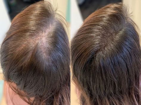 Hair Prp Before And After, Hair Before And After, Hair Filler, Before And After Hair, Best Human Hair Extensions, Prp Hair, Locks Hair, Dramatic Hair, Natural Hair Extensions