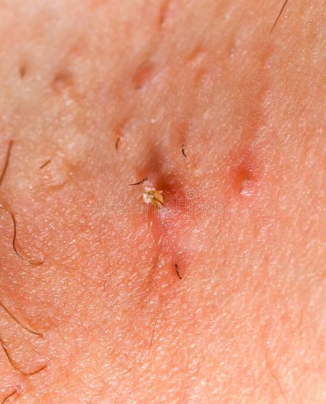 Ingrown hair after shaving. Close up photo of ingrown hair after shaving #Sponsored , #ADVERTISEMENT, #sponsored, #hair, #ingrown, #photo, #Ingrown Gylocic Acid, Hair Aesthetic Picture, Vellus Hair, Cynthia Bailey, Natural Body Lotion, Shaving Tips, Mens Facial Hair Styles, Prevent Ingrown Hairs, Close Up Photo