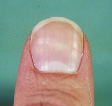 horizontal ridges Horizontal Ridges In Fingernails, Dents In Nails, Horizontal Nail Ridges, Fingernail Ridges, Pitted Nails, Nail Ridges, Nail Beds, Finger Nails, Lines On Nails