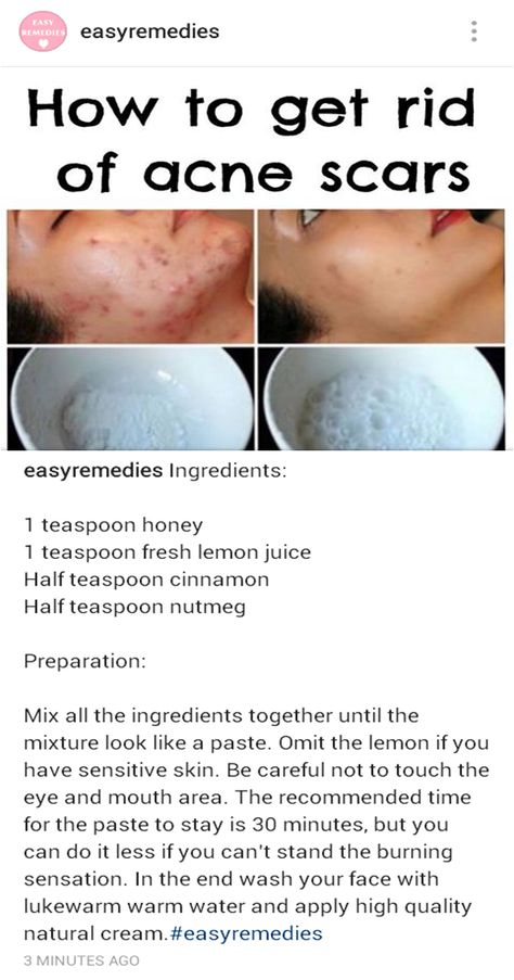 Aleo Vera For Face, Clear Skin Care, Acne Help, Black Skin Care, Facial Rejuvenation, Acne Solutions, Diy Facial, Prevent Acne, Skin Care Routine Steps