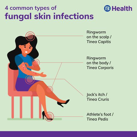 16 Home Remedies For Fungal Infections and Prevention Tips Ringworms In Humans, Tinea Corporis, Tinea Pedis, Natural Antifungal, Skin Fungus, Fungal Infection Skin, How To Help Nausea, Natural Face Cleanser, Holistic Health Remedies