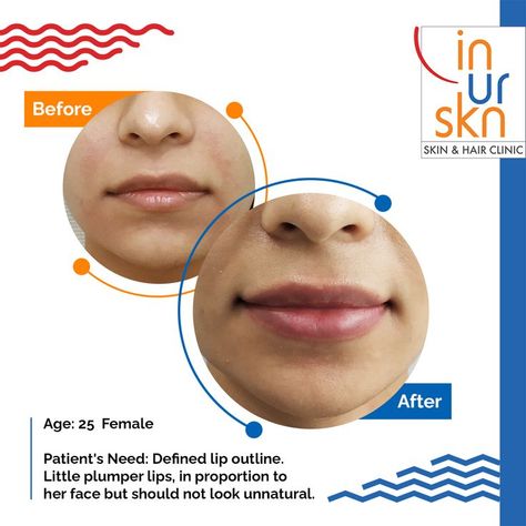 Wishing for fuller lips? We recently made it possible for a young patient to have the kind of lips she desired. Walk in to our clinic in Powai, Mumbai or call +91 9819286930 / 9326028277 to book an appointment with Dr Sejal. Choose InUrSkin #foryourskin. #fullerlips #fillers #fillersinjection #fillersbeforeandafter #injectables #injectablefillers #injectableskincare #injectabletreatments #injectableskincare Powai Mumbai, Lip Outline, Skin And Hair Clinic, Fuller Lips, Beautiful Morning Quotes, Injectables Fillers, Lip Filler, Lip Enhancement, Lip Plumping