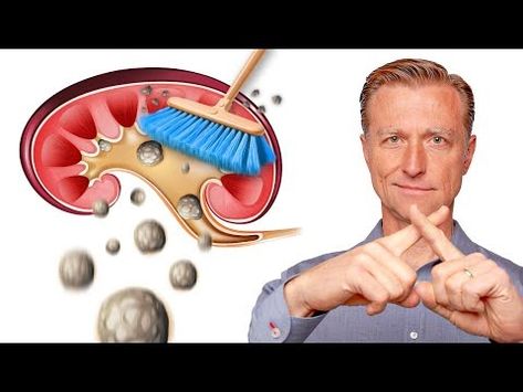 Clean Out Your Kidneys of Oxalates and Stones - Dr. Berg - YouTube Renal Physiology, Low Oxalate Diet, Oxalate Diet, Ab Diet, Dr Eric Berg, Eric Berg, Dr Berg, Nutrient Deficiency, Embrace The Journey