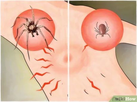 How to Identify a Spider Bite: 7 Steps (with Pictures) - wikiHow Itching Skin Remedies, Treating Mosquito Bites, Spider Bites Pictures, Brown Recluse Spider Bite, Remedies For Mosquito Bites, Bug Bites Remedies, Aloe Vera Lotion, Spider Bite, Brown Recluse Spider