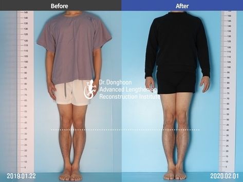 1 year after undergoing cosmetic leg lengthening surgery with Lengthening Over Nail (LON) method. This patient has increased 6.5cm in both tibia. LON method is with external fixator and internal fixator which allows faster recovery compared conventional external fixating method. Limb Lengthening, Growing Taller, Surgery, 1 Year, Health