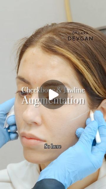 Dr. Lara Devgan, MD, MPH, FACS on Instagram: "Nonsurgical cheekbone and jawline augmentation techniques contribute to facial symmetry and harmony. Through the strategic use of dermal fillers, these procedures enhance facial contours, restoring youthful volume and balance to the midface and lower face regions. 

#facialoptimization #devganoptimization #plasticsurgery #plasticsurgeon #beautyisinthedetails" Cheekbone Filler, Face Balancing Fillers, Facial Balancing Filler, Facial Balancing, Facial Symmetry, Dermal Fillers, Med Spa, Plastic Surgeon, Plastic Surgery