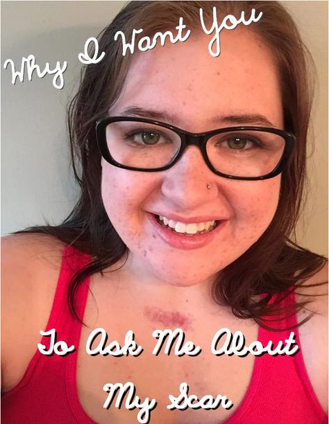 Why I want you to ask my about my #thyroid scar. Thyroid Surgery Recovery, Post Thyroidectomy, Thyroid Surgery Scar, Congenital Hypothyroid, Thyroid Ultrasound, Total Thyroidectomy, Thyroid Surgery, Post Op, Ask Me