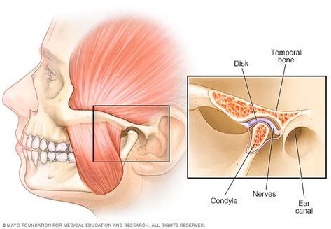 TMJ disorders - Symptoms and causes - Mayo Clinic Neck Muscle Anatomy, Tmj Relief, Jaw Exercises, Referred Pain, Jaw Pain, Head Pain, Body Joints, Tooth Pain, Mayo Clinic