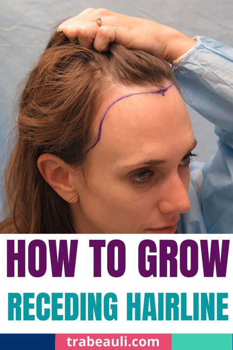 receding hairline style Hair Growth For Receding Hairline, Hairstyles For Women With Receding Hair, Female Receding Hairline, How To Fix Hairline Women, Types Of Hairlines Women, How To Grow Receding Hair Line, Women Receding Hairline Hairstyles, How To Hide Receding Hairline Women, Hair Styles For Receding Hairline Women