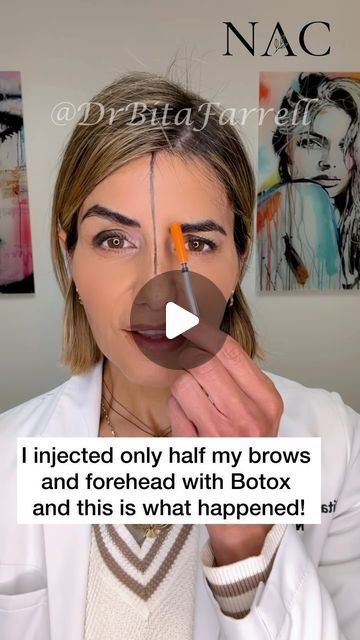 Dr. Bita Zadeh Farrell on Instagram: "Neuromodulators can be used to shape the brows and give them a lift.  Understanding facial anatomy, muscle function and vector pull is key to achieving pleasing results.  The glabellar muscles (procerus supercilii and corrugators) pull the inner brows in and down.  The obicularis oculi pulls the lateral brow in and down.  By relaxing these muscles and allowing the frontalis to dominate, you can achieve a brow lift.   Please note that individual results vary and those with moderate to severe upper lid heaviness may require surgical correction.   #browlift #browliftbotox #botoxbrowlift #botoxtraining #drbitafarrell #naturalaestheticscenter" Brow Lift Botox Eyebrows, Brow Lift Before And After, Eyebrow Lift Botox Before And After, Botox Brow Lift Before And After, Brows Lift, Face Muscles Anatomy, Botox Eyebrow Lift, Botox Eyes, Endoscopic Brow Lift