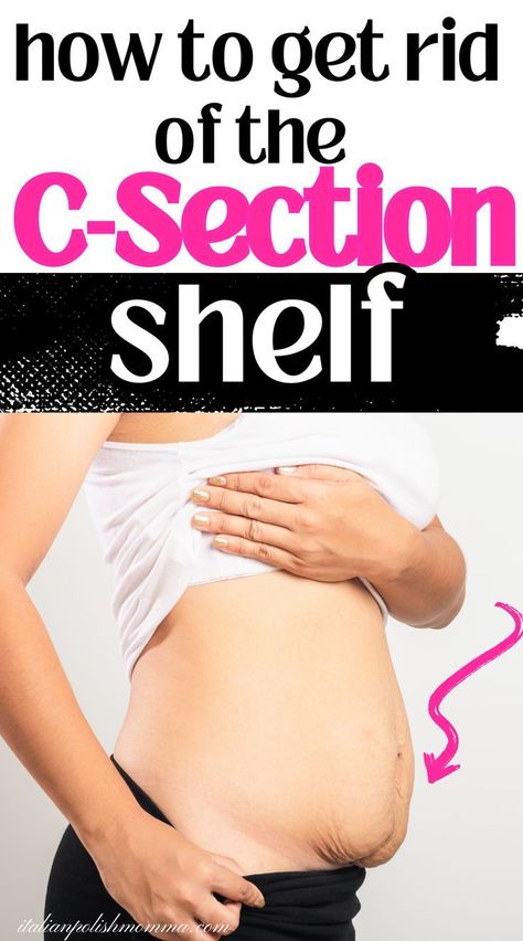 Get Rid Of The Postpartum C-Section Shelf or Belly Pooch Excersise For Belly Flat Stomach After C Section, Workout For Flat Stomach After C Section, Stomach Overhang Exercise, C Section Belly Exercises, Ab Workout After C Section, Workout Post C Section, Post Cesarean Workout Exercises, Csection Postpartum Exercise, C Section Scar Massage