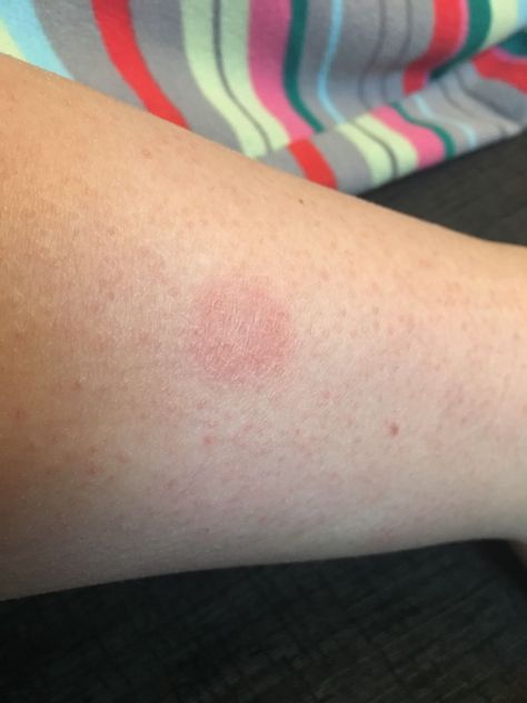 [Skin Concerns] I have a hard dry patch of skin on my leg. Not typical dry skin. Also growing. Any help or suggestions? Brown Patches On Skin, Baby Dry Skin, Dry Skin Causes, Organic Skin Care Recipes, Dry Skin On Face, Dry Skin Patches, Skin Science, Skin Spots, Cream For Dry Skin