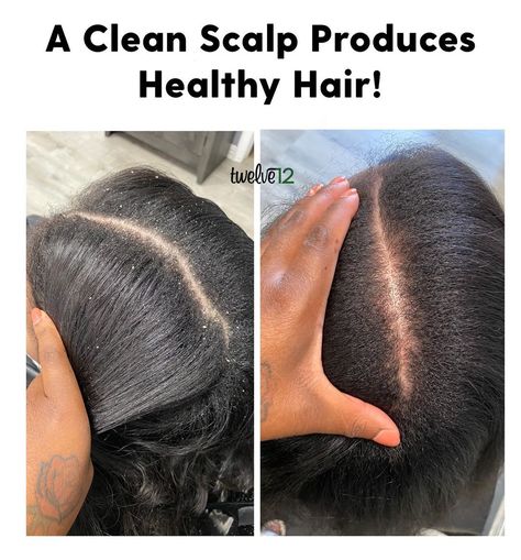 Clear Scalp, Clean Scalp, Embracing Diversity, Natural Hair Care Tips, Hairstyle Trends, Healthy Natural Hair, Women's Hairstyles, Scalp Care, I Can Tell