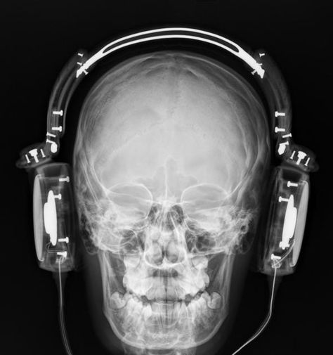 http://radiopaedia.org/cases/headphone-cord-closed-fracture Headphones Aesthetic Black, X Ray Aesthetic, Skull Xray, Ios 16 Icons, Skull With Headphones, Xray Art, Photo Layers, Black And White Picture Wall, X Rays