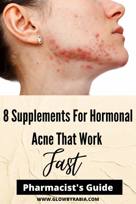 Natural Remedies for Acne - DocPe Natural Remedies for Acne Best Vitamins For Skin Acne, Best Skincare Products For Acne, Supplements For Acne, Hormonal Acne Supplements, Acne Supplements, Cystic Acne Remedies, Homemade Skincare, Blind Pimple, Pimples Under The Skin