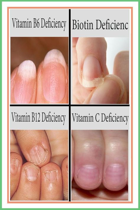 Nail Health Signs, Nail Structure, Vitamin B6 Deficiency, Fingernail Health, Nail Signs, Mineral Deficiency, Zinc Deficiency, Nail Vitamins, B12 Deficiency