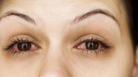 Pink eye and allergies have similar symptoms like itchy, watery eyes. The difference between pink eye and allergies is that pink eye is very contagious. Pinkeye Remedies, Bloodshot Eyes, Eye Twitching, Calendula Benefits, Eye Infections, Coconut Health Benefits, Diy Kosmetik, Watery Eyes, Benefits Of Coconut Oil