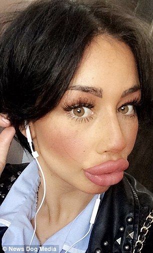 Before and after: The 30-year-old has had 6.5ml of dermal filler injected into her lips in less than a year Star Lips, Big Lips Natural, Lip Pictures, Wax Lips, Plastic Surgery Fail, Botox Lips, Plastic Surgery Gone Wrong, Fake Lips, Bright Lipstick