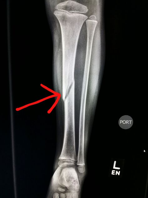 #Leg #xray shows a #spiral #fracture of the #tibia in a #child. #radiologist #radiology #trauma Leg Xray, Leg Bandage Snapchat, Shopping Snap, Radius Bone, Beard And Mustache Styles, Arm Bones, X-ray Images, Plant Styling, Bone Fracture