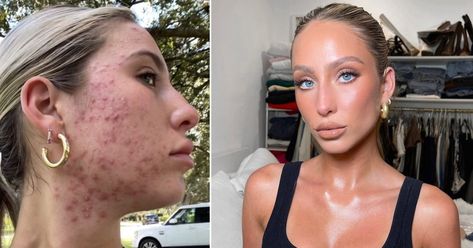 'You are beautiful, your skin does not define who you are.' Celebs With Acne, Accutane Before And After, Acne Journey, Skin Journey, Insecure People, Alix Earle, What Is Trending Now, Severe Acne, Bumpy Skin